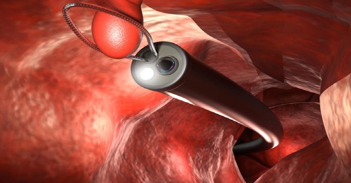 best colonoscopy in gurgaon, best colonoscopy doctors in gurgaon, best colonoscopy services in gurgaon, c